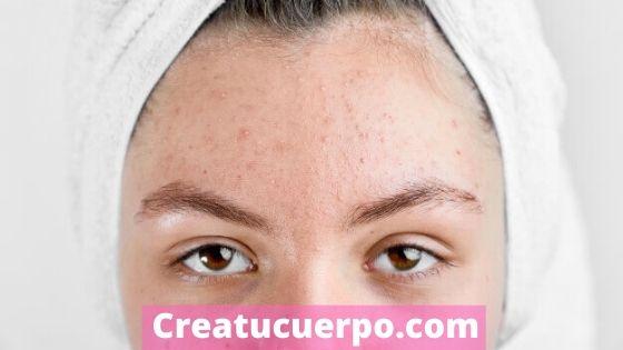 fix acne on your dry skin