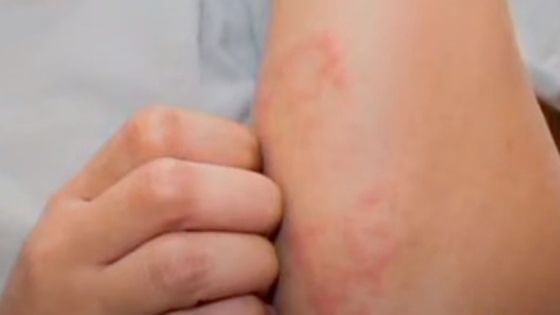 ¿Por qué salen las manchas rojas en la piel por nervios o estrés?