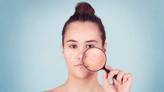 ¿Qué recomiendan los dermatologos para el acné?